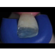 IVOCLAR - Ivoclar IPS Empress Direct – For highly aesthetic restorations
