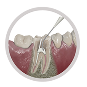 Cementation of Root Posts Cementation of Root Posts