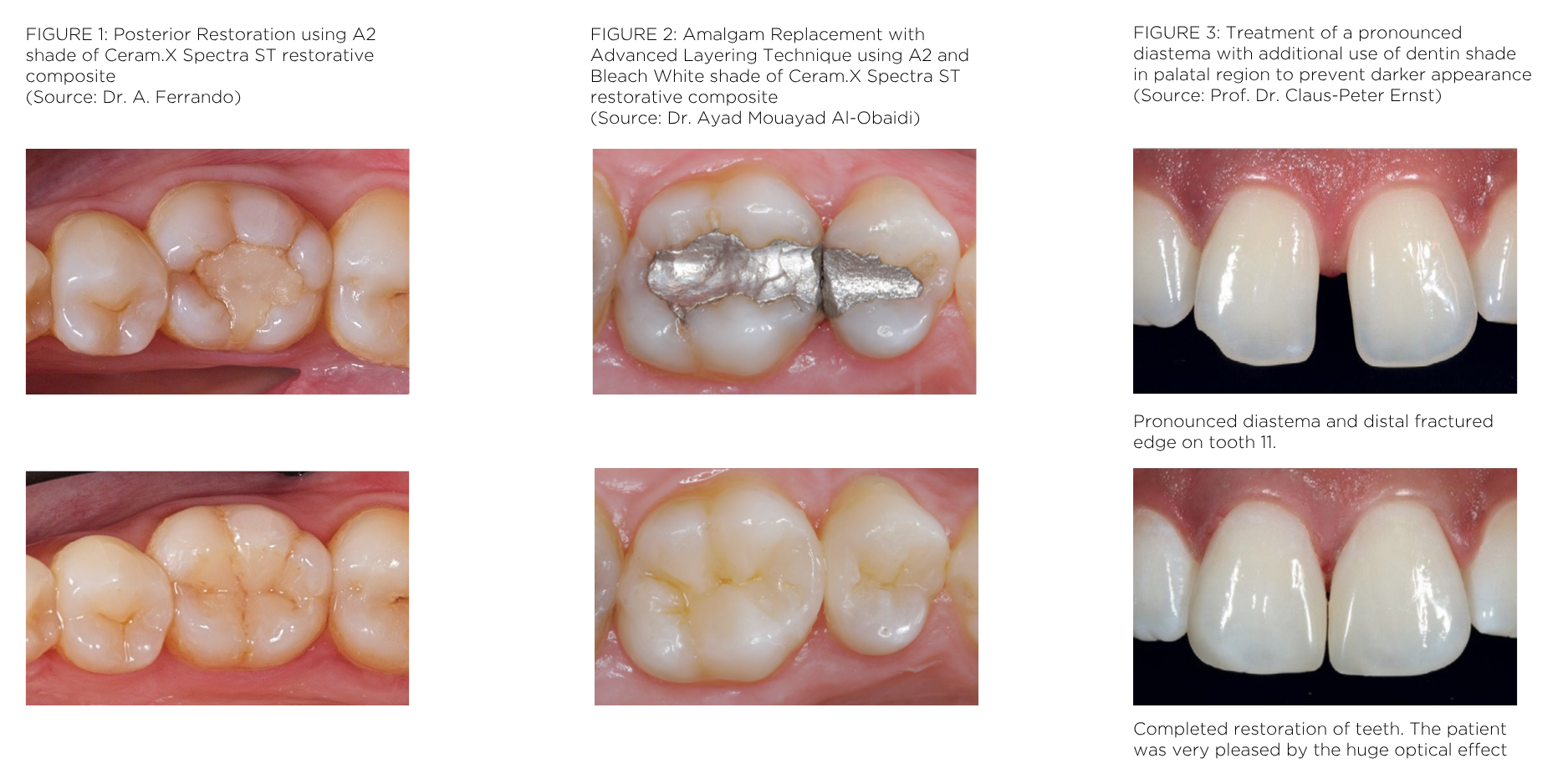 Dentsply Ceram.X How To Use Dentsply Ceram.X How To Use