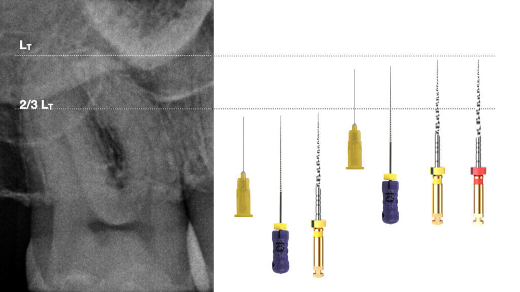 Go-Taper X Files - Operatory Sequence