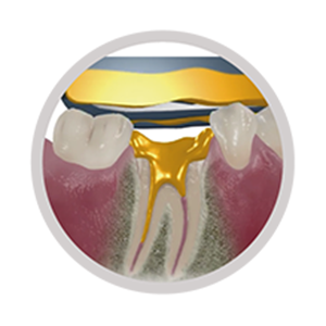 Impression of Root Canal Impression of Root Canal