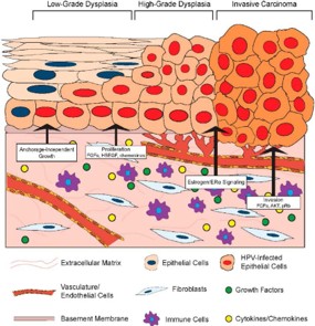The Stages Of Dysplasia And The Use Of Fluorescence In Preventive Screening. The Stages Of Dysplasia And The Use Of Fluorescence In Preventive Screening.