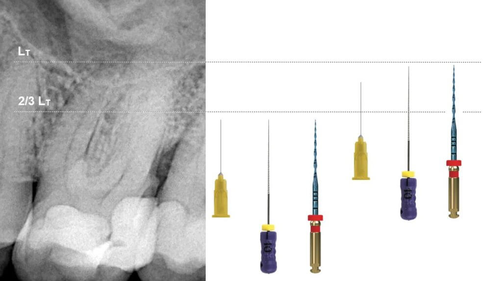 Access Reverso Blue Files - Operatory sequence