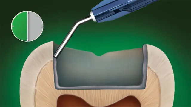 iBond Etch Application - Step 1