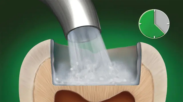 iBond Etch Application - Step 2