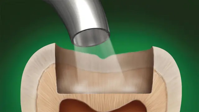 iBond Etch Application - Step 3